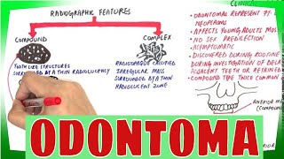 Odontoma  Types Clinical features Histopathological Features amp Treatment [upl. by Ynetsed]