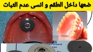 الحل النهائي و الاقتصادي لتثبيت طقم الأسنان المتحرك في الفم بقوة Prothèse dentaire amovible [upl. by Syned712]