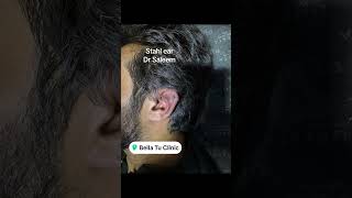 Stahl ear deformity correction by dr Saleem stahlear otoplasty drsaleemplasticsurgeon [upl. by Teresita842]