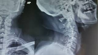 Cervical Spondylosis on Xray [upl. by Nitsu868]