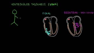 Ventriküler Taşikardi VT Fen Bilimleri Sağlık ve Tıp [upl. by William]
