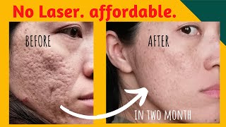 【Affordable】Finally I found something that works for my acne scars【acne scar removal】 [upl. by Irpac]