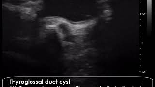 CASE 763 Thyroglossal duct cyst [upl. by Najed593]