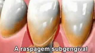 Periodontia Doença Periodontal Gengiva Retração Gengival Espaço Perio Odontologia [upl. by Amery]