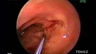 ENTERORRAGIA TIFICA Video del servicio de apoyo de gastroent [upl. by Buderus]