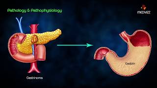 ZollingerEllison syndrome ZES  Animated lecture usmle step 1 pathology  Dr Bhanu prakash [upl. by Otiragram8]