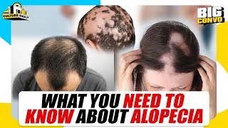 What You Need To Know About Alopecia [upl. by Ziana]