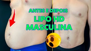 ANTES E DEPOIS LIPO HD MASCULINA [upl. by Eeimaj]