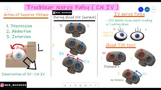 Trochlear Nerve Palsy  CN IV  Why Head Tilt   Action of Superior Oblique Med Madness [upl. by Llij]