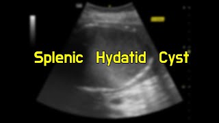 Splenic Hydatid Cyst [upl. by Koal]