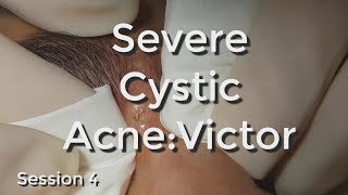 Severe Cystic Acne  Victor Session 4 [upl. by Read]