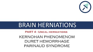 BRAIN HERNIATIONS 44 Uncal herniationDuret Hemorrhage Kernohan Phenomenom amp Parinaud Syndrome [upl. by Notyard]