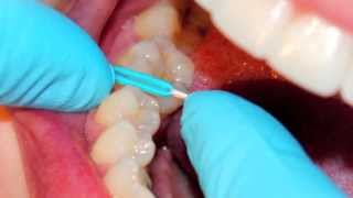 PHM Orthodontists Separator Video [upl. by Ytram835]