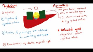 Hydatid disease of liver [upl. by Shelden]