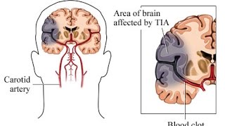 Transient Ischemic Attack TIA [upl. by Langill]