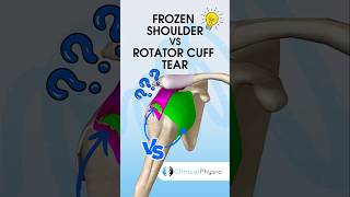 Frozen Shoulder vs Rotator Cuff Tear physiotherapy physicaltherapy frozenshoulder rotatorcuff [upl. by Joappa]