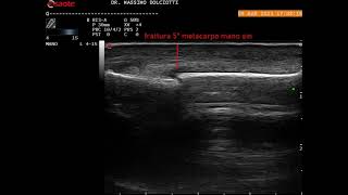 frattura del 5° metacarpo della mano sinistra [upl. by Misti]