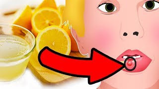 Natural Cures for Mucocele Mucous Cyst  How I treat it [upl. by Ailina698]