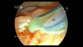 Severe Cholangitis  ERCP [upl. by Tynan349]