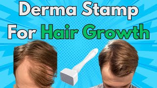 This Is Why You Should Add A Derma Stamp To Your Hair Growth Routine  Derma Stamp x Minoxidil Combo [upl. by Sanjiv]