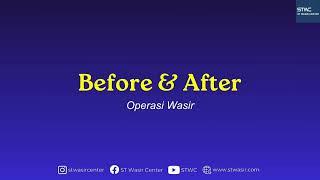 BEFORE AFTER OPERASI AMBEIEN  WASIR MODERN DI ST WASIR CENTER [upl. by Rimola]