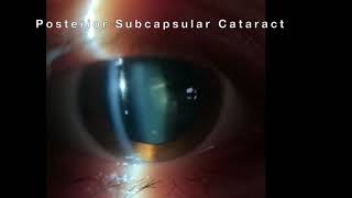 Posterior Subcapsular Cataract PSC [upl. by Enilatan]