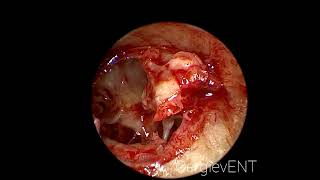 Endoscopic tympanosclerosis and atresia EAC surgery [upl. by Rani]