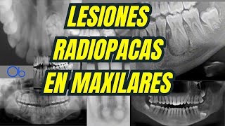 Lesiones Radiopacas en Maxilares 💀🩻 [upl. by Ymmaj]