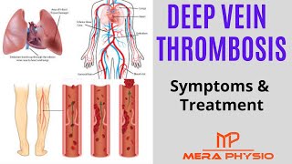 Deep Vein Thrombosis DVT  Causes Symptoms Treatment Exercises  In Hindi  Mera Physio [upl. by Eintruoc]