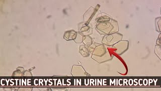 Cystine crystals seen in urine microscopyBest crystals view in microscopeUrine routine examination [upl. by Vere]