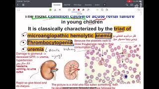 hemolyticuremic syndrome [upl. by Elyrad155]