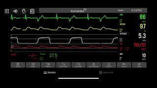 Electrical Alternans [upl. by Aronos]