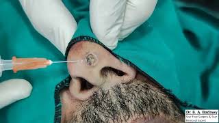 Scarless Nasal mole removal [upl. by Walke]