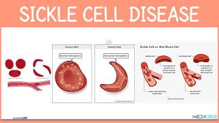 Sickle cell Disease Simplified [upl. by Yorgo917]