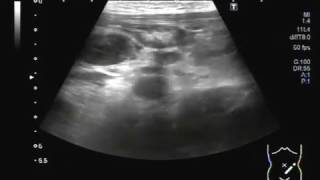 Ultrasound Video showing Mesenteric lymphadenitisLymphadenopathy or adenopathy [upl. by Mckale55]