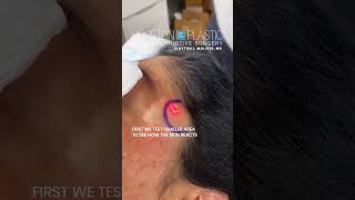 Laser treatment for hyperpigmentation oddlysatisfying hyperpigmentation [upl. by Ylac]