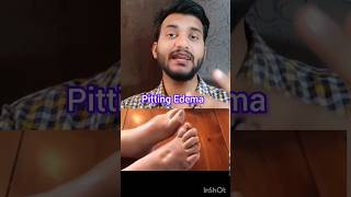 Pitting edema shorts [upl. by Eslud]