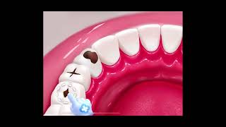 Ultimate Guide to Teeth Cavity Treatment  BeautyByte Animations [upl. by Fem]