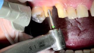 Emax Cad Cerec Brigde Full clinical case in PAG technique c Dr J Raynal [upl. by Ennaj]