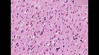 Histopathology BrainAstrocytoma [upl. by Eden901]