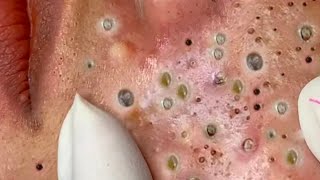 crazy satisfying blackhead removal Face cleaning and Beautification86248 [upl. by Eniamrehc64]