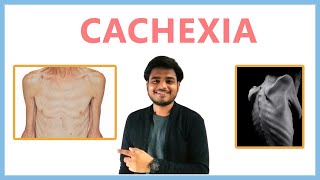 Cachexia wasting syndrome [upl. by Odlonyer]