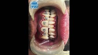 Class 2 div 1 Malocclusion  BRACES trending dentist toothdental dentalcare dentalclinic tooth [upl. by Allenaj]