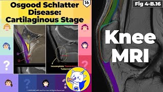 Fig 4B16 Osgood Schlatter Disease Cartilaginous Stage [upl. by Ramej]