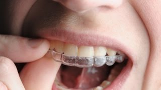 Pulire lapparecchio per i denti i consigli dell odontoiatra [upl. by Suirtimid]