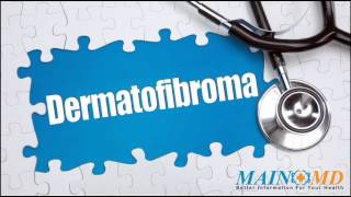 Dermatofibroma ¦ Treatment and Symptoms [upl. by Tennies]