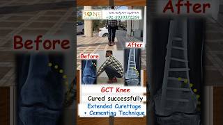 Giant Cell Tumour Knee GCT Bone Tumour cured by extended curettage technique Dr Rajat Gupta shorts [upl. by Oetam]