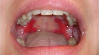 الفقاع الشائع ‏او ‏Pemphigus vulgaris [upl. by Rusticus]