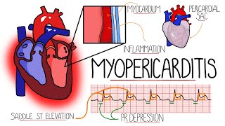 Myocarditis amp Pericarditis Myopericarditis Explained [upl. by Elise]