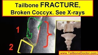 Xrays showing COCCYX FRACTURE broken tailbone [upl. by Tare]